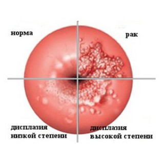 Дисплазия шейки матки