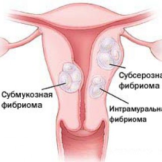 Фибромиома матки