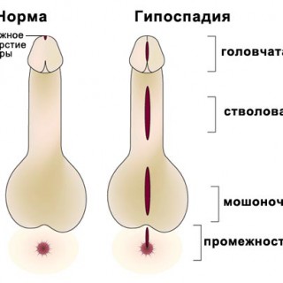 Гипоспадия