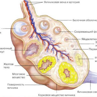 Киста желтого тела яичника
