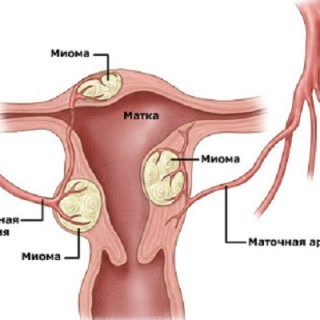 Миома матки