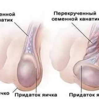 Перекрут яичка