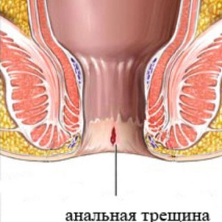 Анальная трещина