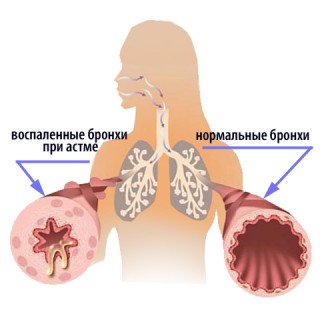 Бронхиальная астма